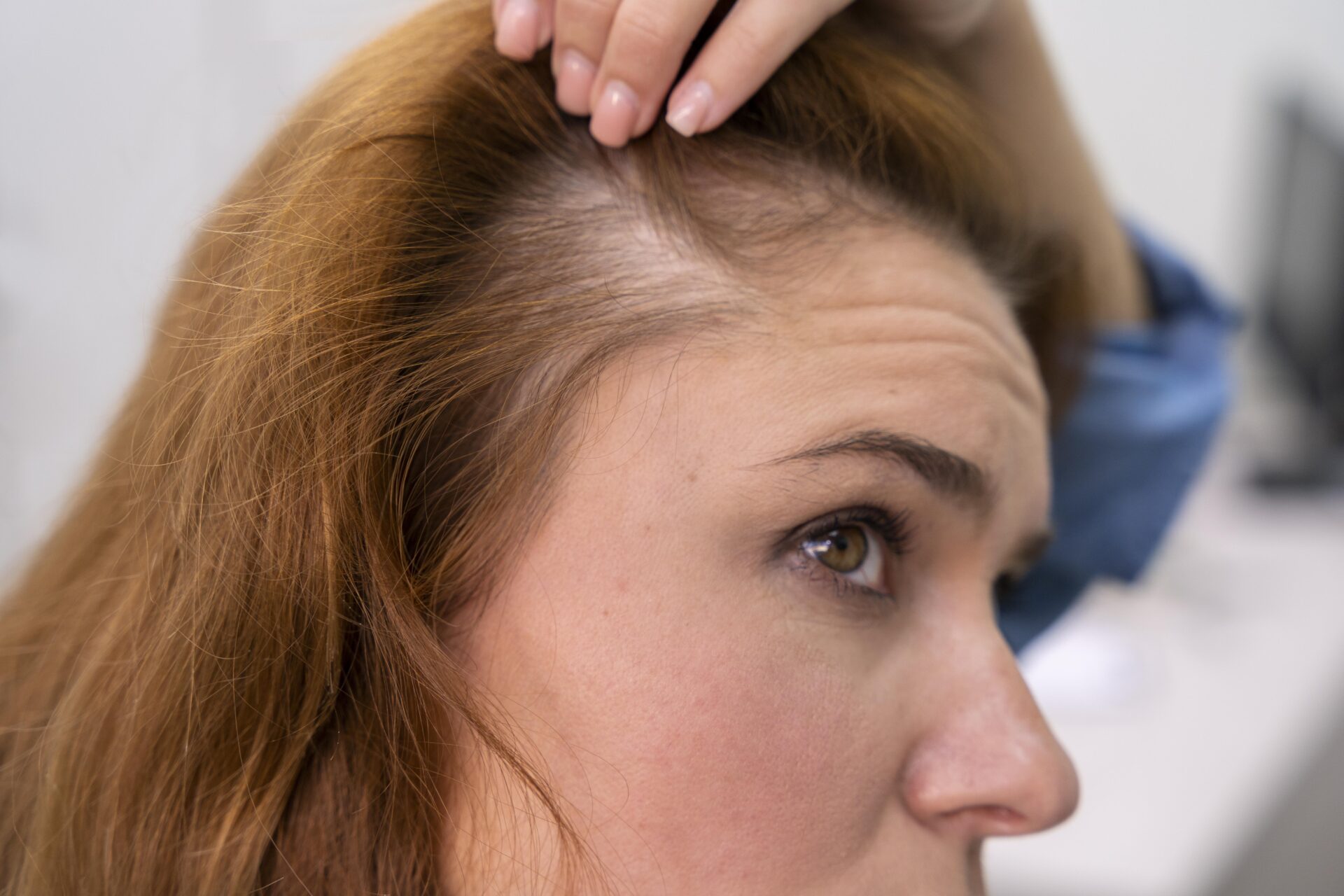 Hair loss for female